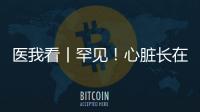 医我看丨罕见！心脏长在右胸膛
！珠海成功开展首例“右位心”房颤射频消融术