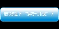显微镜下“穿针引线”7小时	！金湾这家医院成功帮患者保住断肢